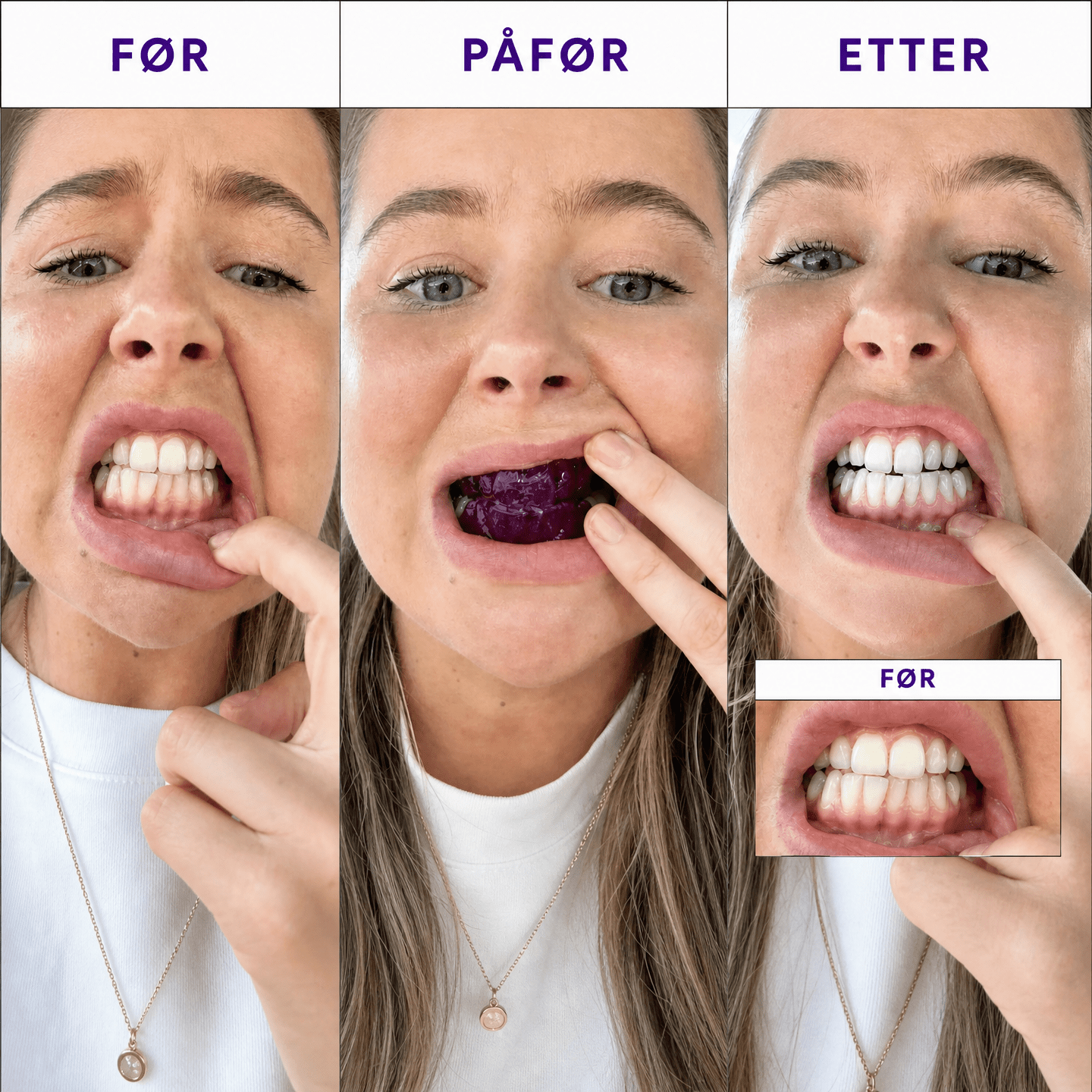 Hismile™ Whitening Strips - Nordligsmil