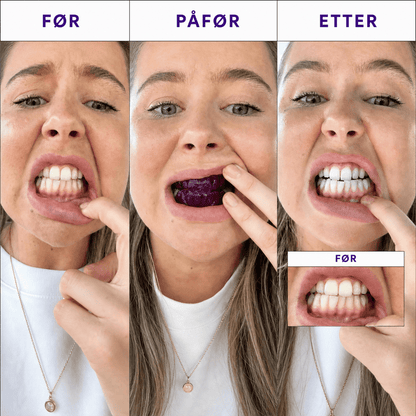 Hismile™ Whitening Strips - Nordligsmil